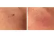 Discover Skin Care New York's effective skin tag, mole, and spot removal with laser tech, offering up to 50% off. - Second Medium