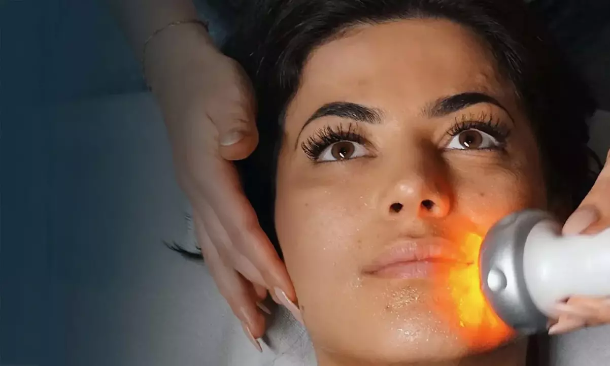 30 Min. Radiofrequenz Hautstaffung für das Gesicht für 1 Person (25% sparen) - Primary Image