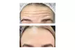 20 or 40 Units of Wrinkle-Reducing Cosmetic Injectable at Perfecta Cosmetic Clinic (Up to 72% Off) - Second Medium