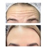 Image 3: Up to 77% Off Cosmetic Injectable at Perfecta Cosmetic Clinic