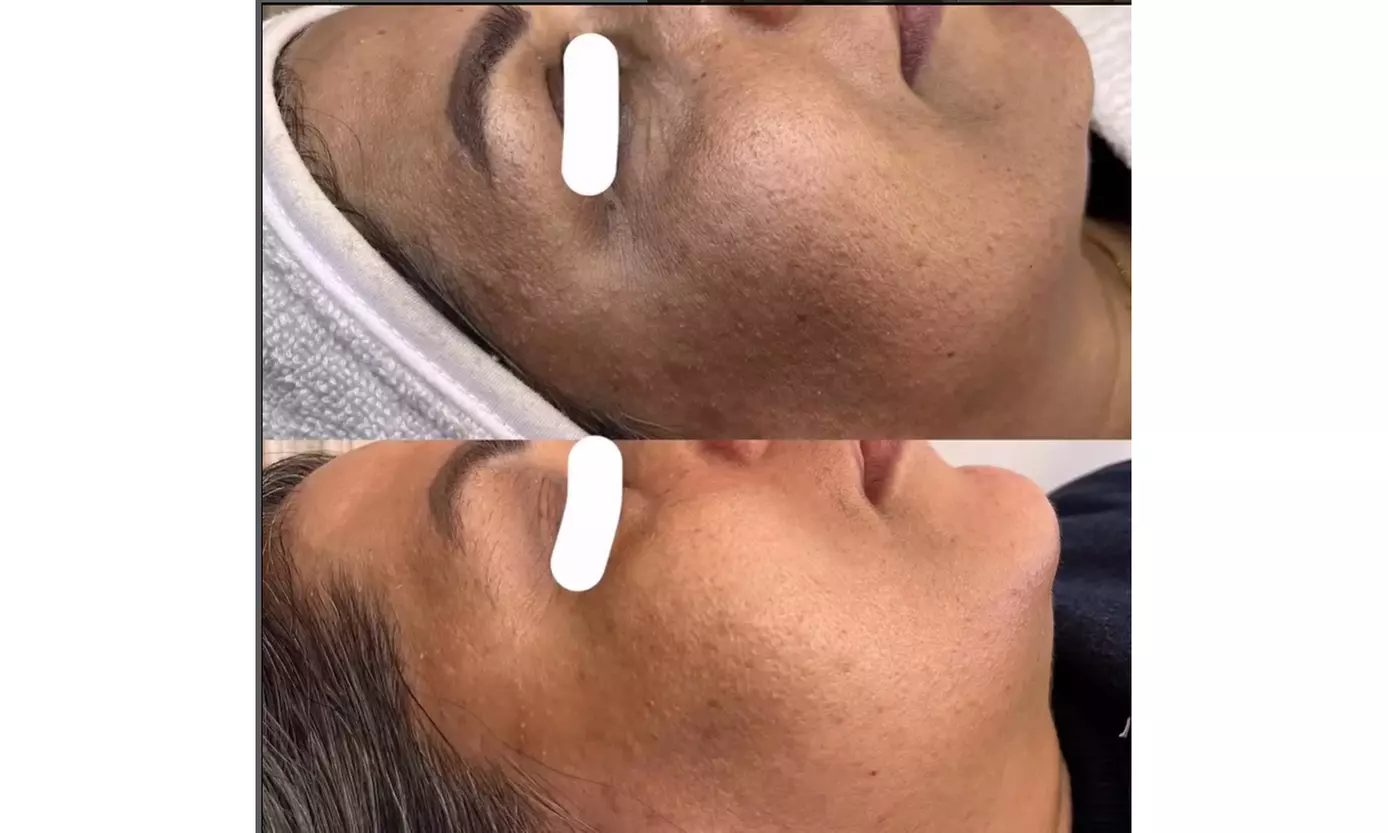 Luxury 1,2 or 3 60-Minute Chemical Peel or Signature Facials