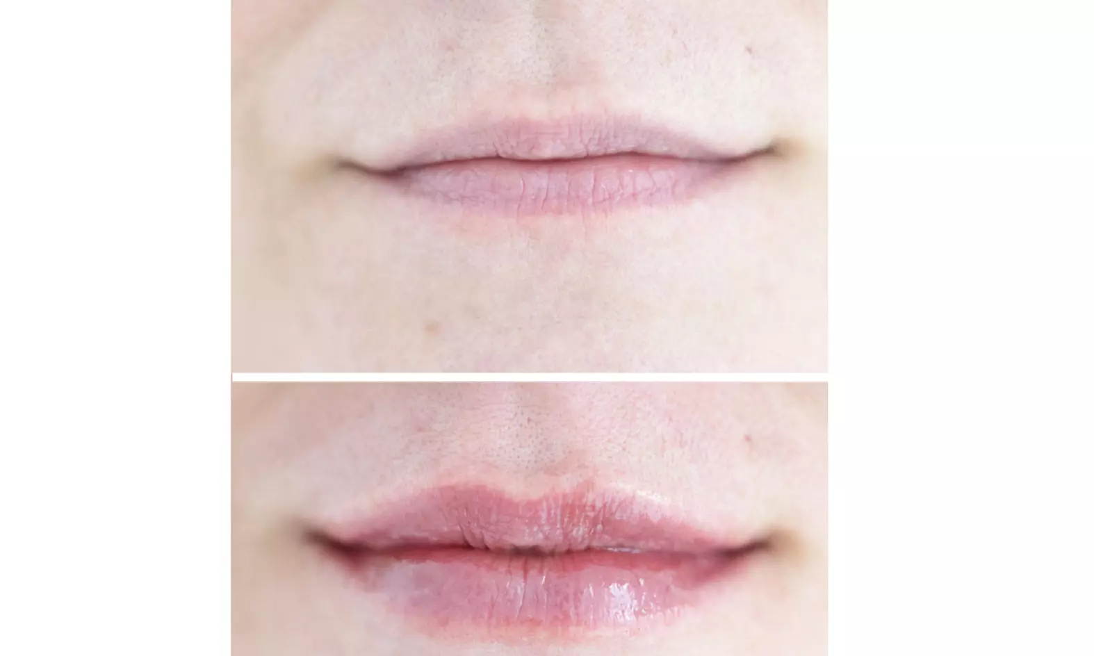 Enhance Your Look with Lip Filler