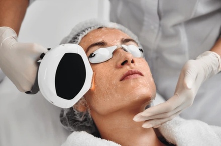 One Lumecca IPL Treatment (Face) - Botox and Filler Lab