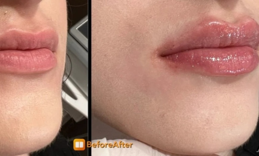 Image 4: Restylane, Sculptra, Radiesse and Kysse for a Fresh Look