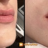 Image 4: Restylane, Sculptra, Radiesse and Kysse for a Fresh Look