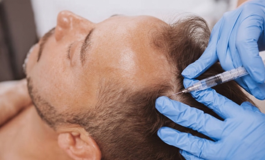 Image 8: PRP for Facial or Hair Restoration with 1, 2, or 4 Tubes