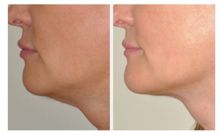 Image 4:  Face or Body (Belly/ Thigh) Fat Reduction W/ Forma Radiofrequency 