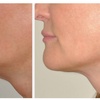 Image 4:  Face or Body (Belly/ Thigh) Fat Reduction W/ Forma Radiofrequency 