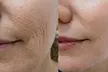 Rebuild Collagen with 2cc, 3cc, 4cc, or 5cc of Sculptra Injections at SlimmThicc Aesthetics Spa (Up to 31% Off) - Second Medium