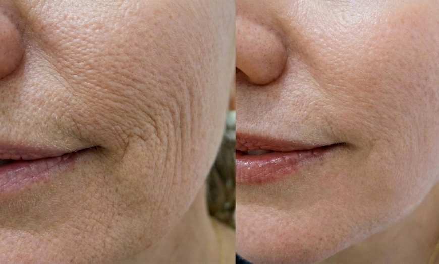 Image 2: Boost Collagen with 2 CC, 3 CC, 4 CC, or 5 CC of Sculptra Injections
