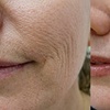 Image 2: Boost Collagen with 2 CC, 3 CC, 4 CC, or 5 CC of Sculptra Injections