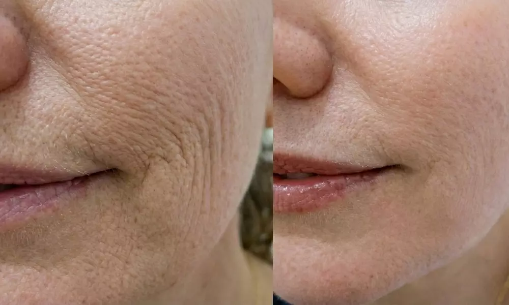 Boost Collagen with 2 CC, 3 CC, 4 CC, or 5 CC of Sculptra Injections