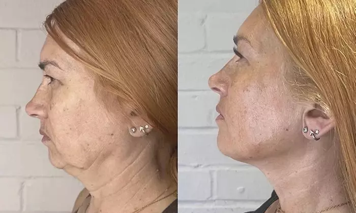 Relax w 1 or 2 Sessions of Brazilian Facial Treatment & Consultations