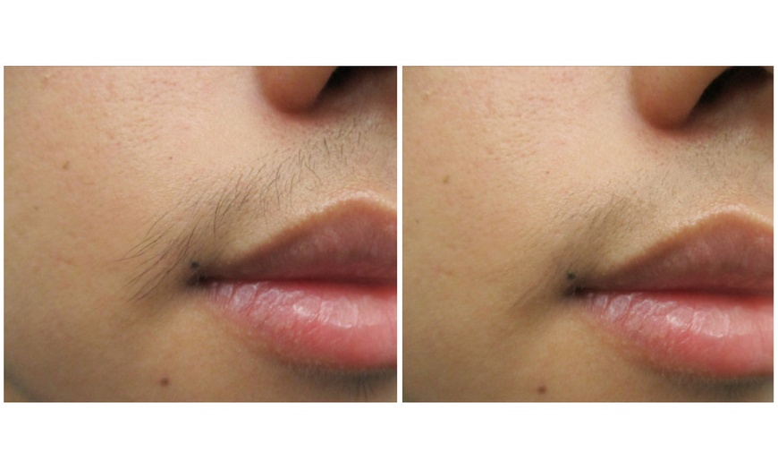 Image 5: 6 Sessions of Laser Hair Removal in Small, Medium, Large Areas & More