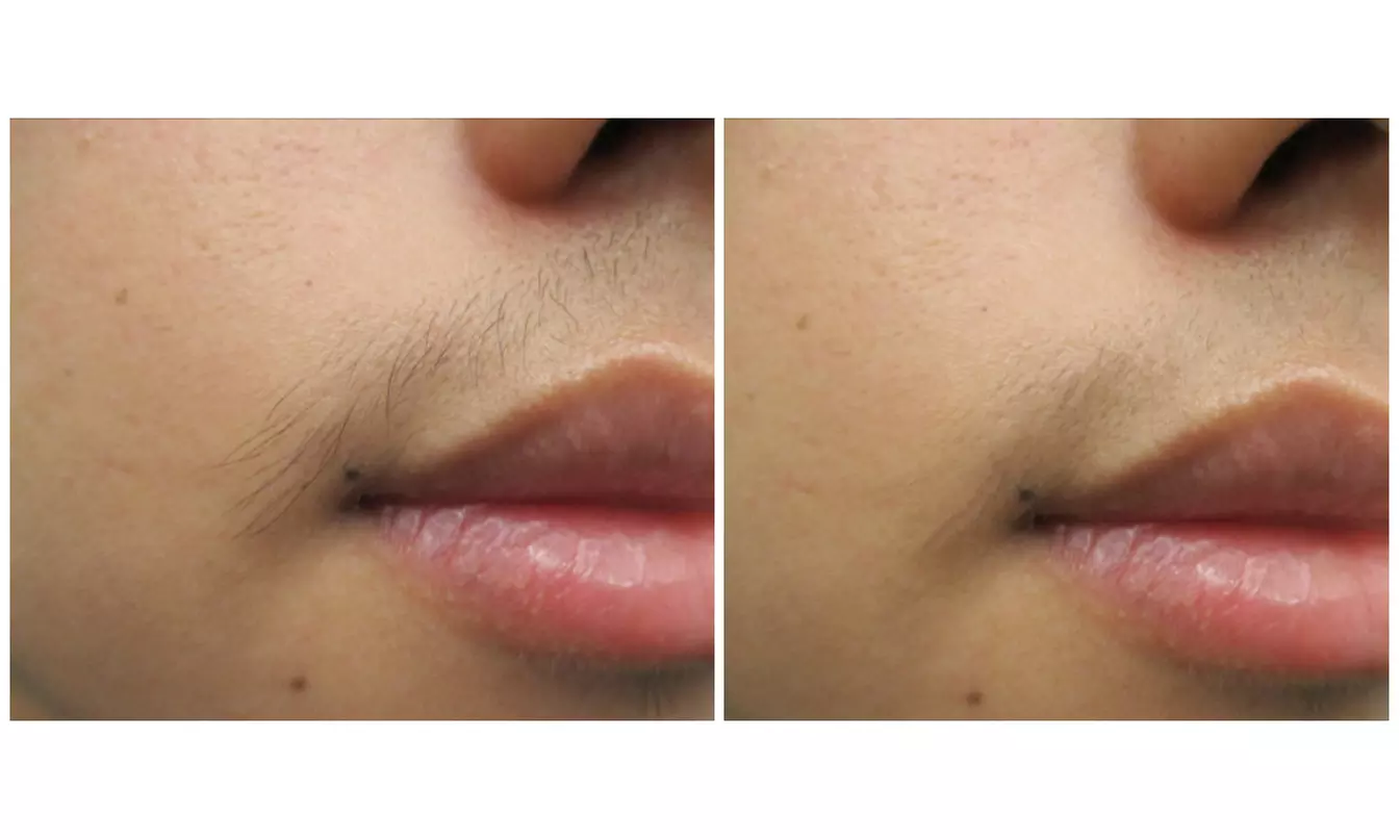6 Sessions of Laser Hair Removal in Small, Medium, Large Areas & More