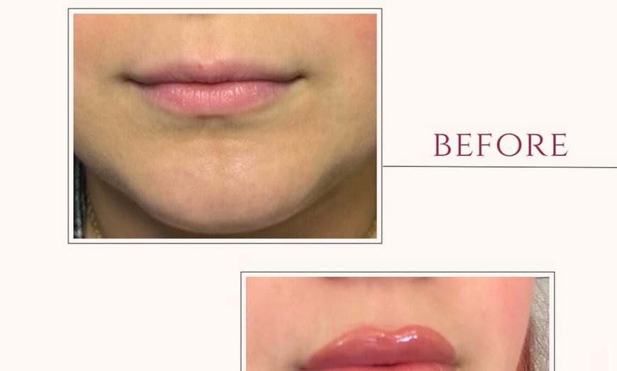 Image 2: Achieve a Refreshed Look with 20, 40, or 60 Units of Botox