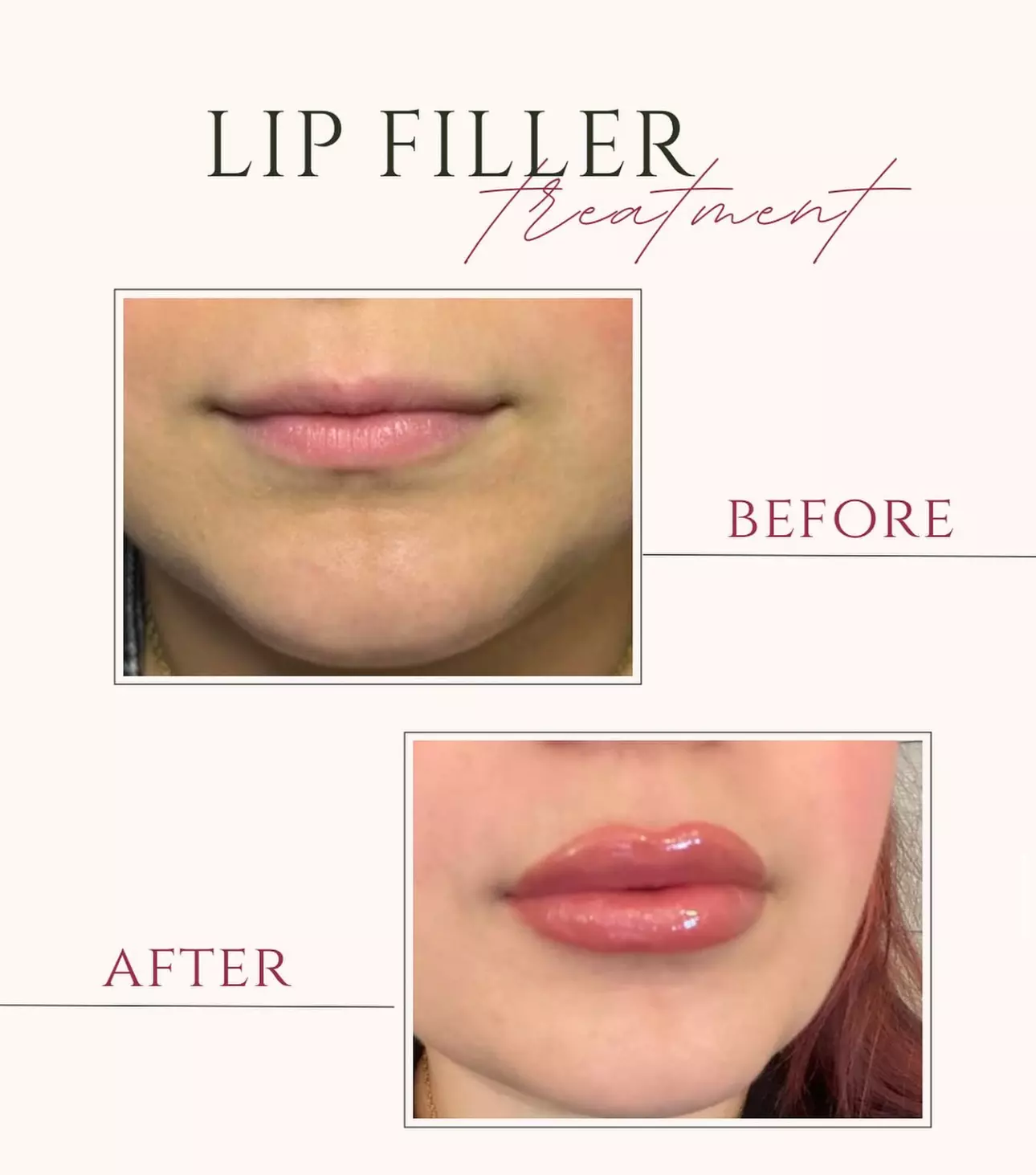 Achieve a Refreshed Look with 20, 40, or 60 Units of Botox