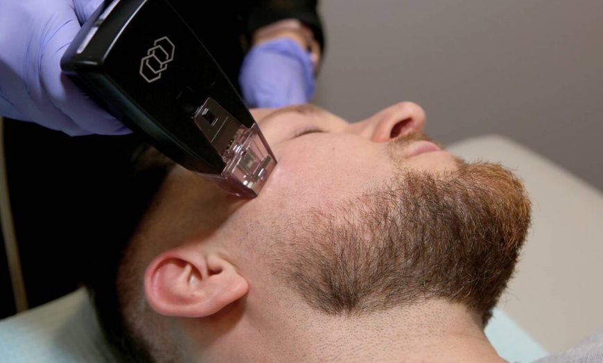 Image 3: ¡Reafirma tu piel! 1 sesión de Morpheus8 facial o corporal de 75 min.