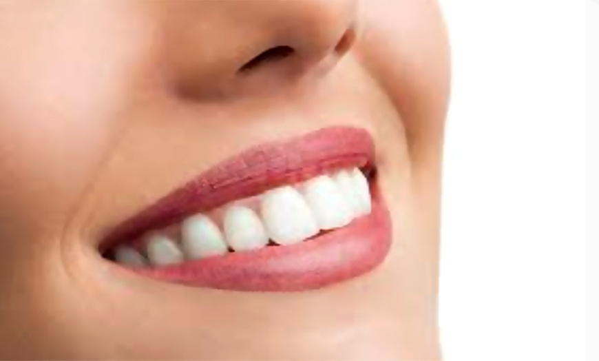 Image 1: 1, 2 ou 3 séances d'éclaircissement dentaire