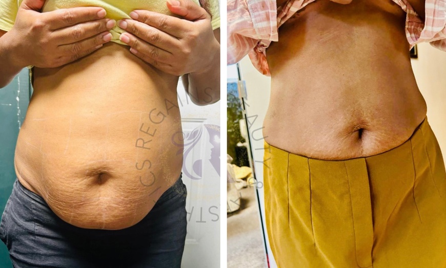 Image 2: Lemon Bottle Fat Dissolving for a Sculpted Face and Body!