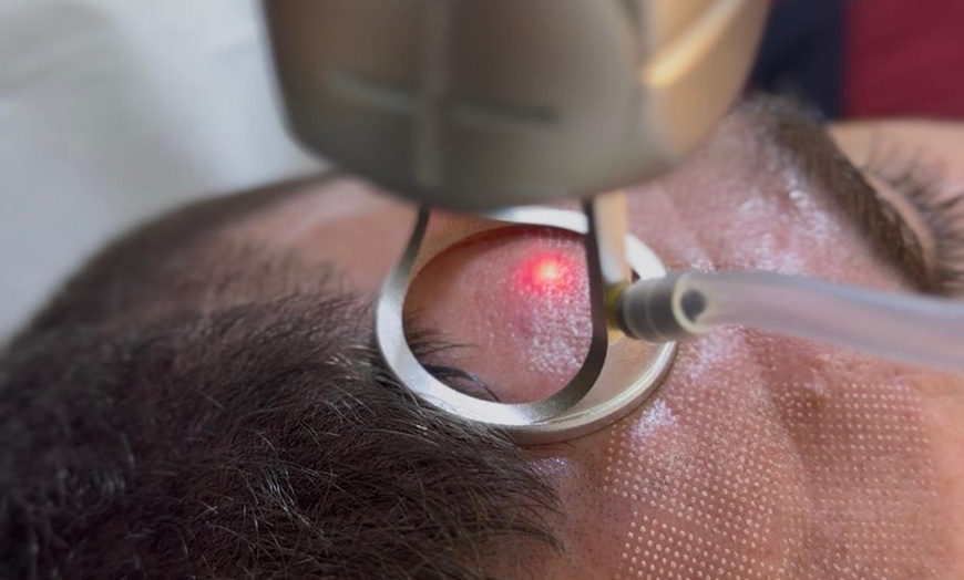 Image 3: 1 o 3 sesiones de rejuvenecimiento facial con láser ‎revitalizante