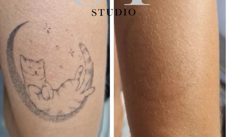 Image 8: Up to 86% Off on Tattoo Removal at Sure Thing Studio