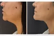 Tratamiento HIFU facial efecto rejuvenecimiento en rostro y opción a papada y cuello para 1; ahorra hasta un 64% - Second Medium