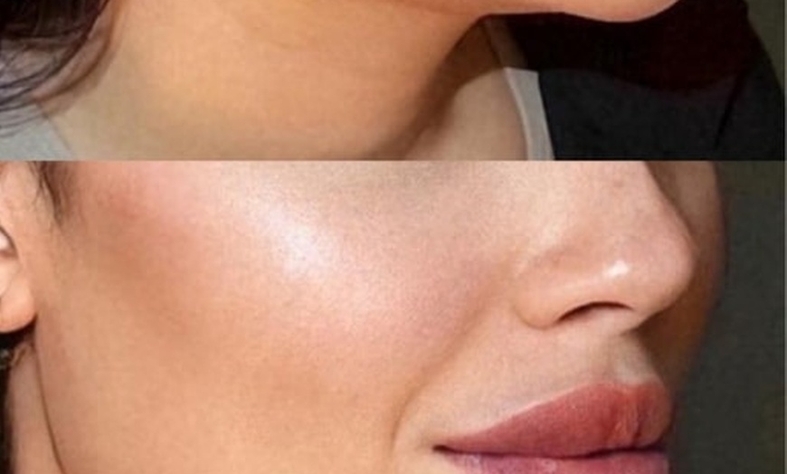 Image 2: Get a Dermal Filler Today: 1ml or 2ml Lips