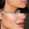 Image 2: Get a Dermal Filler Today: 1ml or 2ml Lips