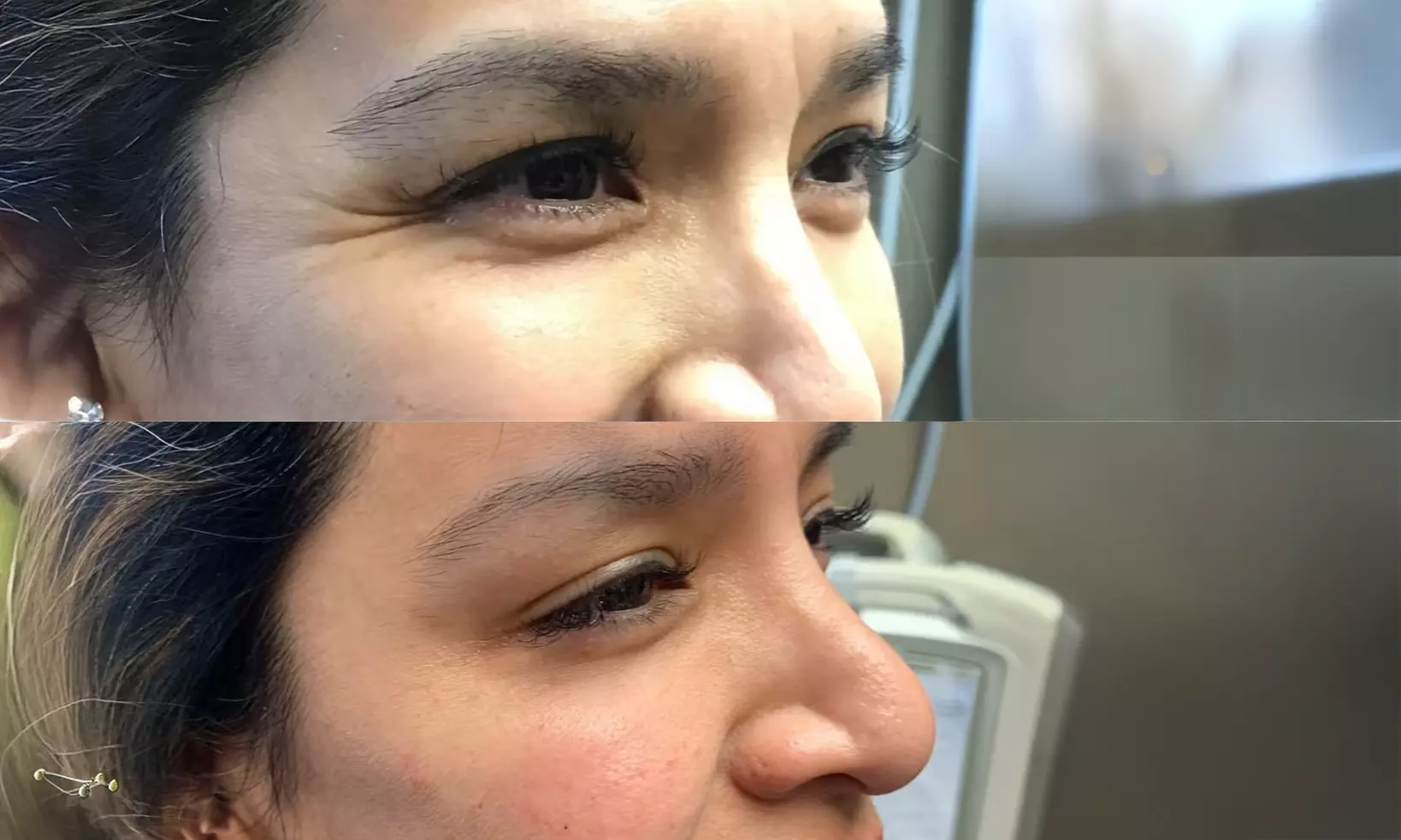 Achieve Youthful Glow with 20 Units of Botox Treatment