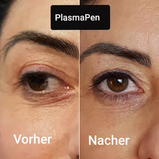 Faltenbehandlung mit dem Plasma-Pen bei Heilpraktikerin Angelika Weber