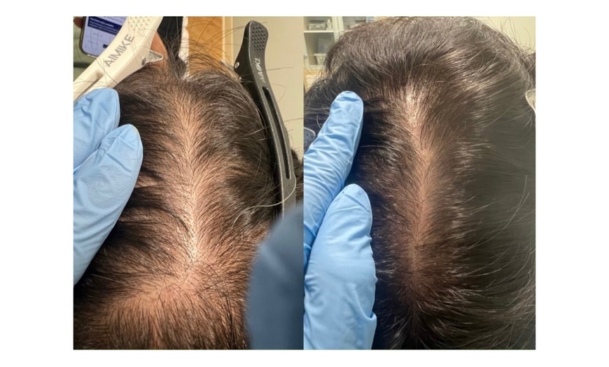 Image 5: Up to 70% Off on Hair Restoration - Non-Surgical at Mar Essence