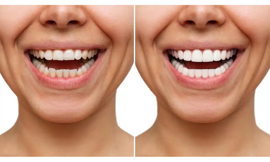Image 2: Blanchiment dentaire chez Triaesthetic