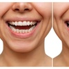 Image 2: Blanchiment dentaire chez Triaesthetic