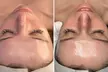 Reveal Glowing Skin with One or Two VI Peel at River Oaks Galleria Medspa (upto 54% Off) - Second Medium