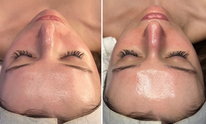 Image 3: Reveal Glowing Skin with One or Two VI Peel