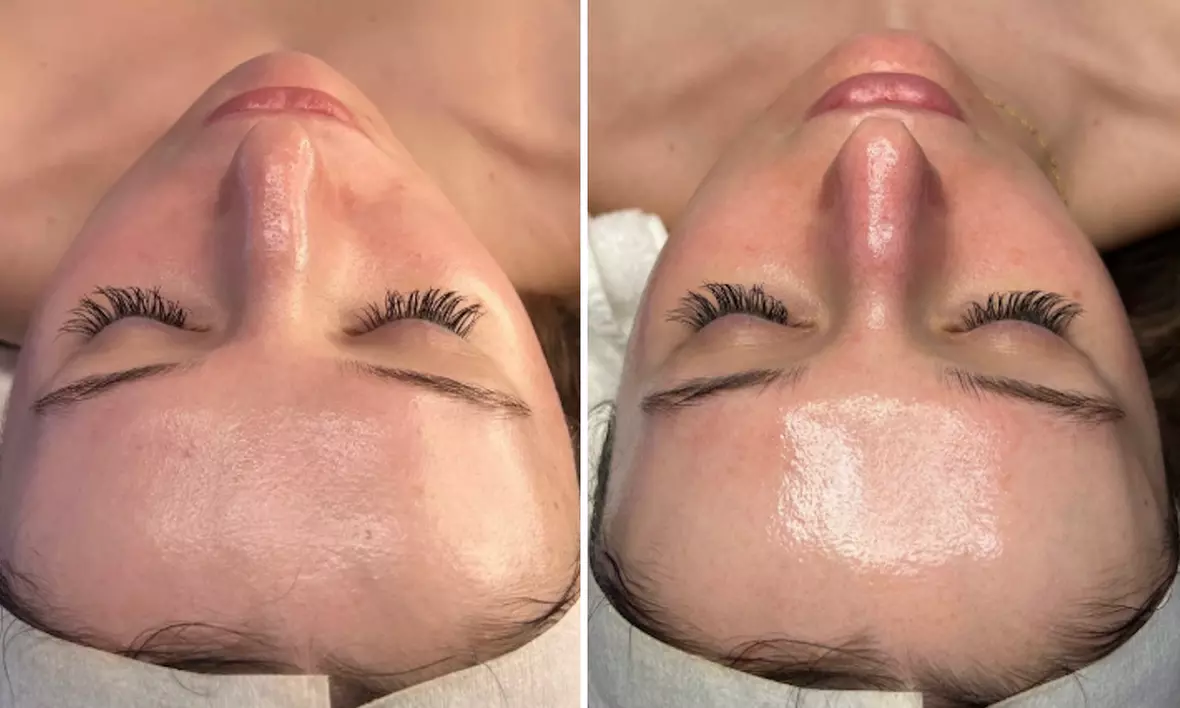 Reveal Glowing Skin with One or Two VI Peel