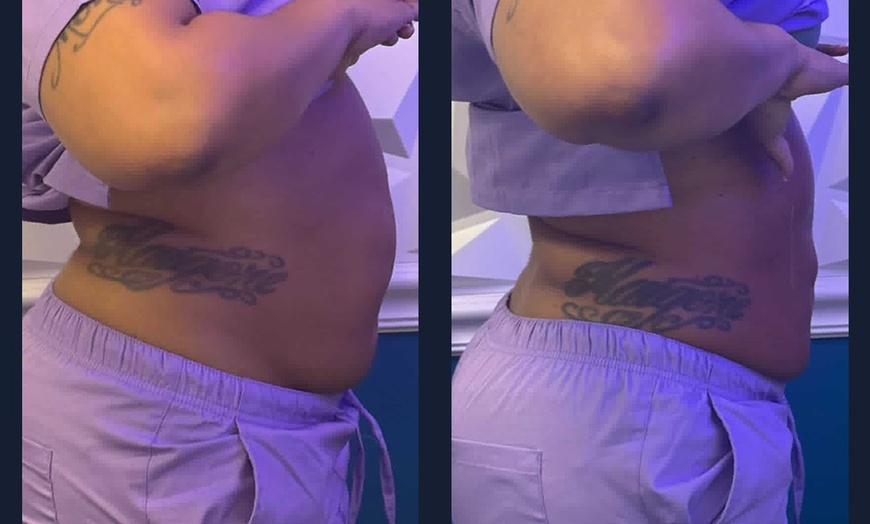 Image 2: Intro Cryo Slimming or 4 or 6 Cryo Contour Sessions