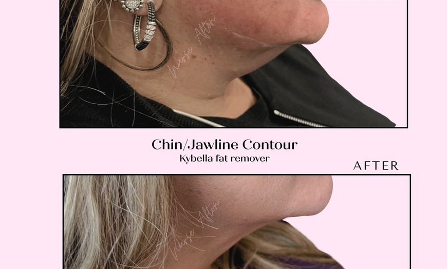Image 3: ✨ Say Goodbye to the Double Chin with Kybella® ✨
