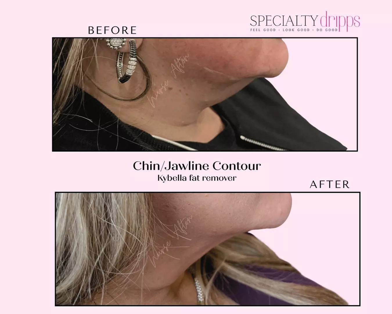 ✨ Say Goodbye to the Double Chin with Kybella® ✨