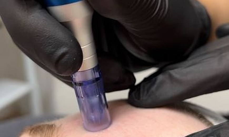 Image 10: Revitalize Your Summer Glow with Luxury Microdermabrasion Facial