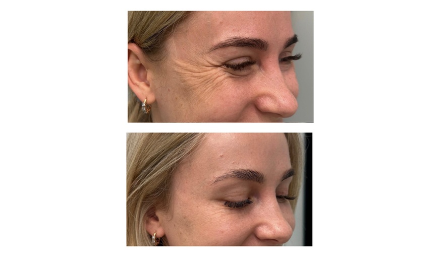 Image 5: Up to 47% Off Botox and Juvéderm at AK Medical Spa