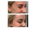 Image 5: Up to 47% Off Botox and Juvéderm at AK Medical Spa