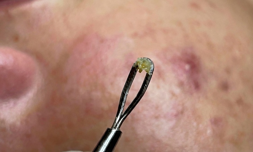 Image 5: 1, 2, or 3 Facials or Upgrade to Dermaplaning/Microdermabrasion
