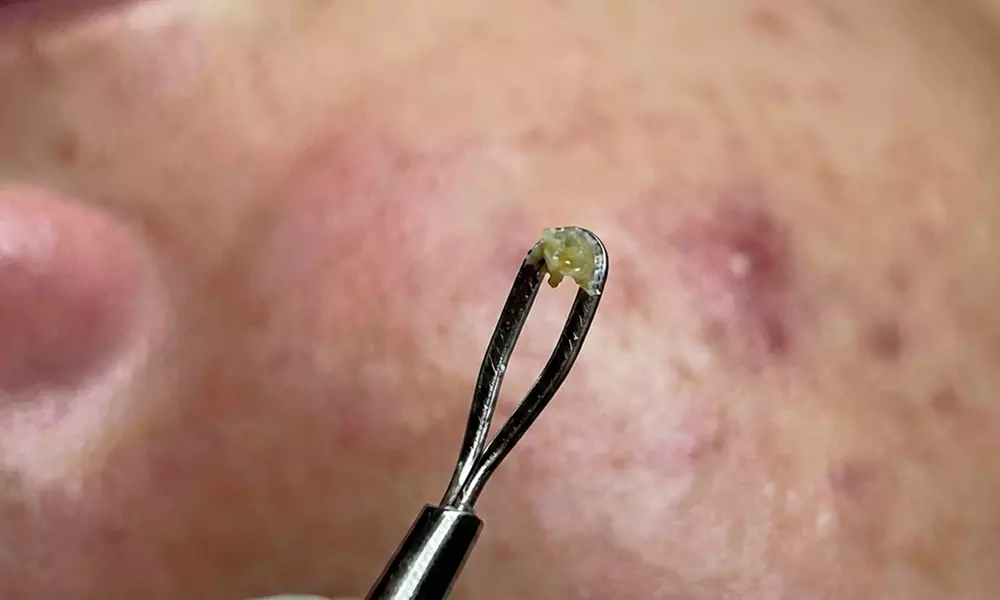 1, 2, or 3 Facials or Upgrade to Dermaplaning/Microdermabrasion