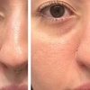 Image 3: One or Three Sessions Of Microneedling with Skin Nourishing Serum