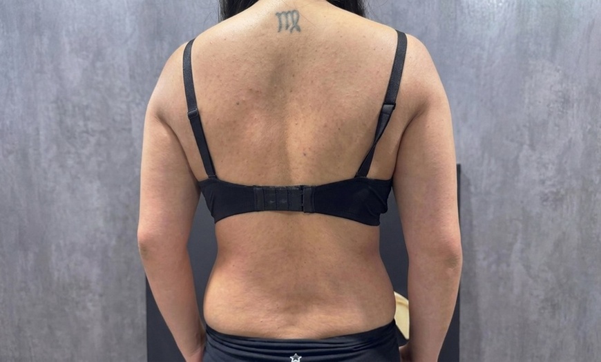 Image 2: Body Sculpting & Cellulite Reduction to Boost Contours & Confidence