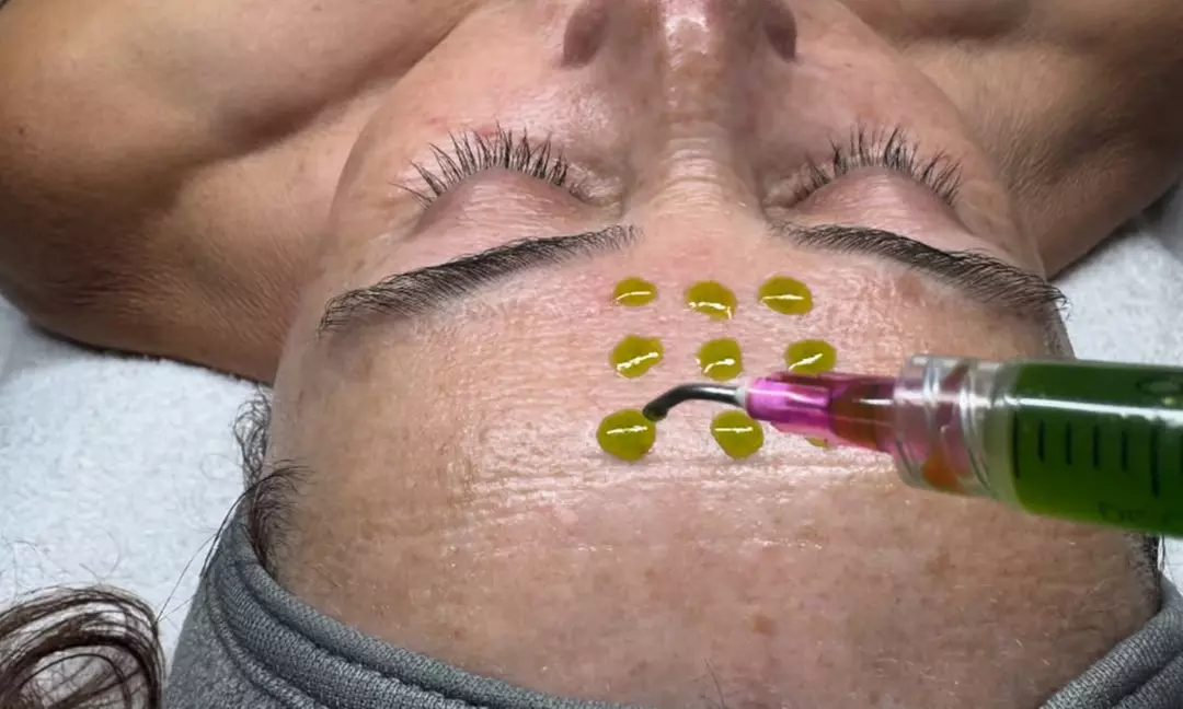 Rejuvenate Your Skin with Chemical Peel or Micro-Needling with Exosomes (Up to 66% Off) - Primary Image