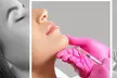 Enhance Your Lips with Half or Full Syringe Revanesse Versa Lip Filler at Glam lab (Up to 50% Off) - Second Medium