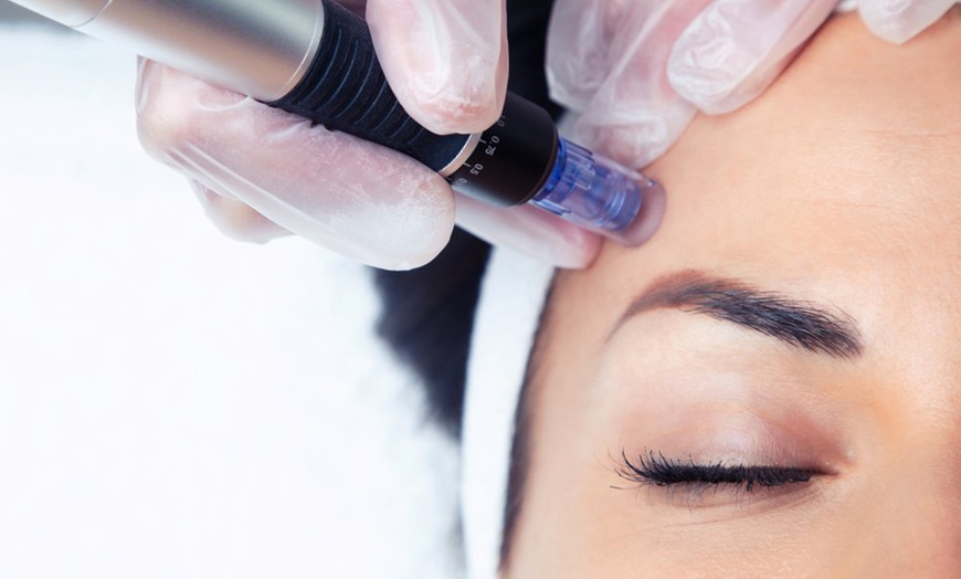 Image 16: 1 o 2 sesiones de rehidratación de labios o microlifting facial para 1